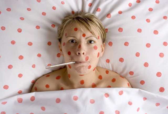 ООН: 70% случаев кори в Европе приходятся на Украину