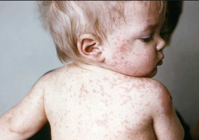 В Украине за неделю корью заболели 1,3 тысячи человек