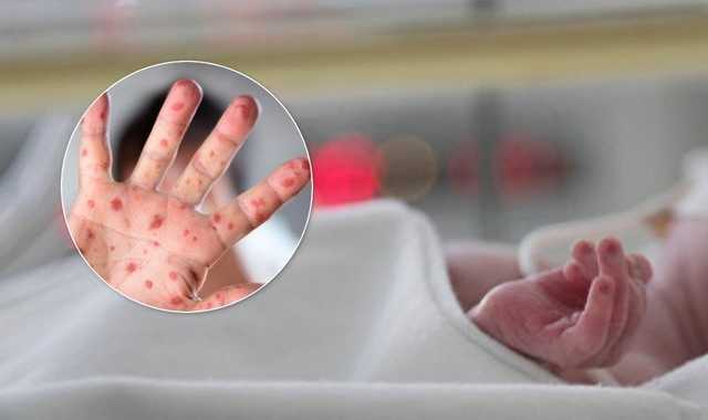 В Ровно трехмесячный ребенок умер от кори