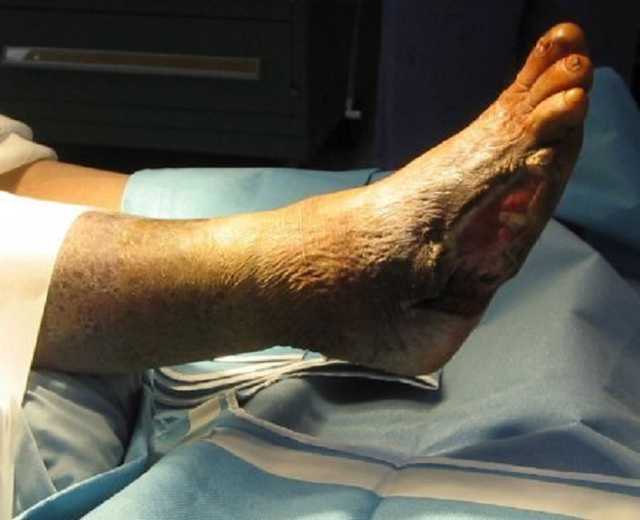 В России пациента заставили самостоятельно захоронить ампутированную ногу