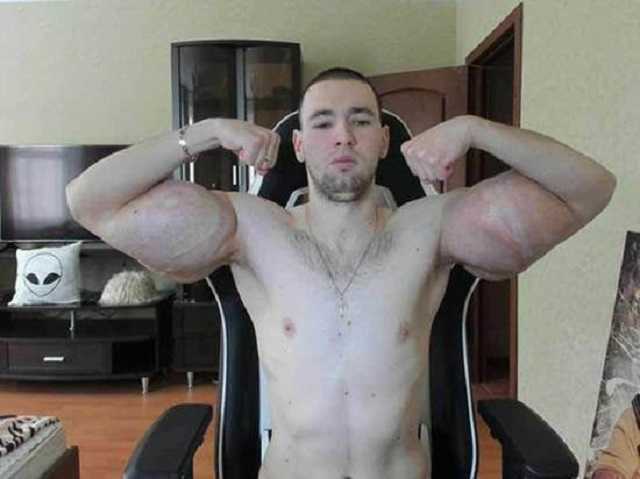 "Руки-базуки" показал сдувшиеся руки после операции