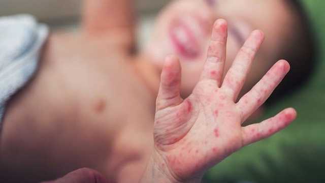 В Украине могут вспыхнуть три смертельные инфекции: медики забили тревогу