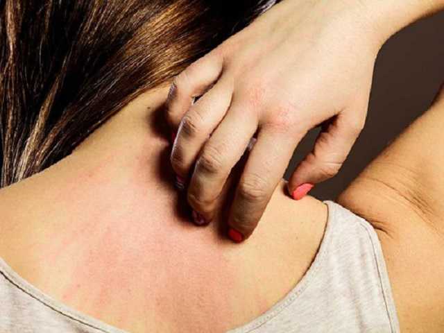 Названы семь возможных видов сыпи при коронавирусе