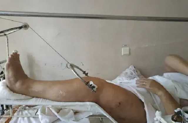 В Кривом Роге женщине посоветовали лечить перелом витаминами. Она умерла