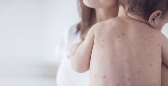 В Украине от кори вакцинированы больше трети годовалых детей