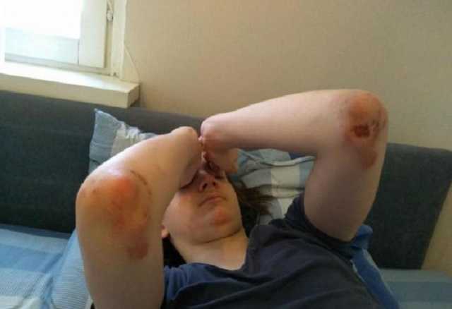 ОМОНовцы трижды избили 14-летнего школьника в Минске: следы от дубинок по всему телу