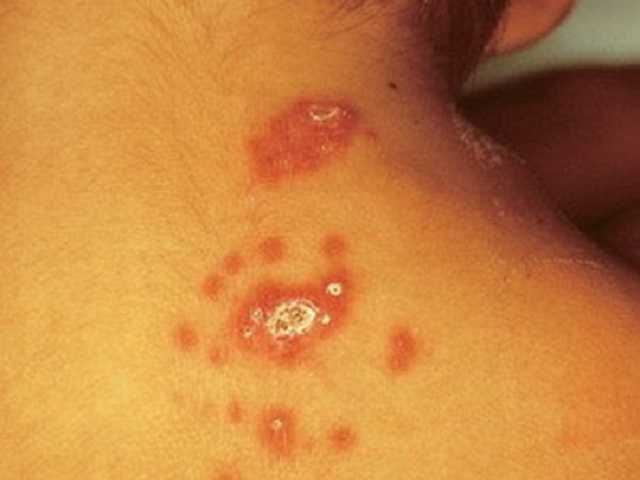 В Украине зафиксировали два случая туляремии: что важно знать об этой болезни