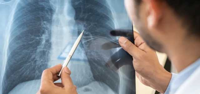 Врачи пересадили легкие пациенту, пострадавшему от коронавируса