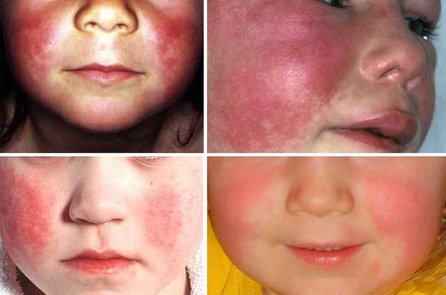 Ученые предупредили о распространении нового, крайне опасного штамма скарлатины