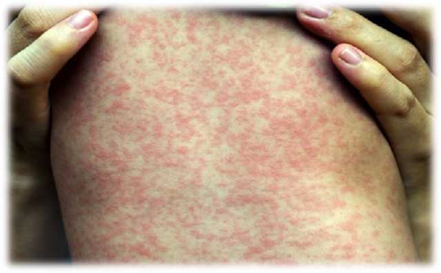 Пандемия COVID-19 может спровоцировать вспышку опасной инфекции – ученые