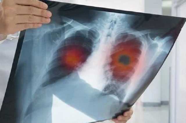 Легкие "ковидников" напоминают печень: патологоанатом окровенно о вскрытиях