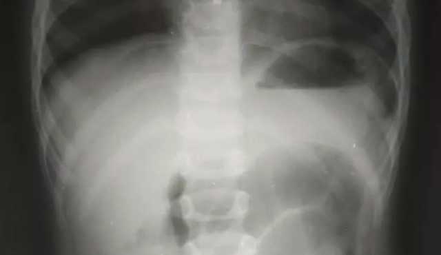 У Львові з 6-річного хлопчика лікарі дістали незвичний предмет