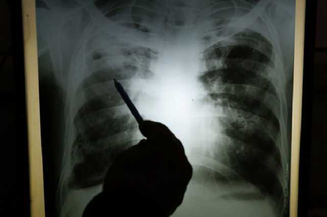 На Буковині 9-річний хлопчик помер від пневмонії