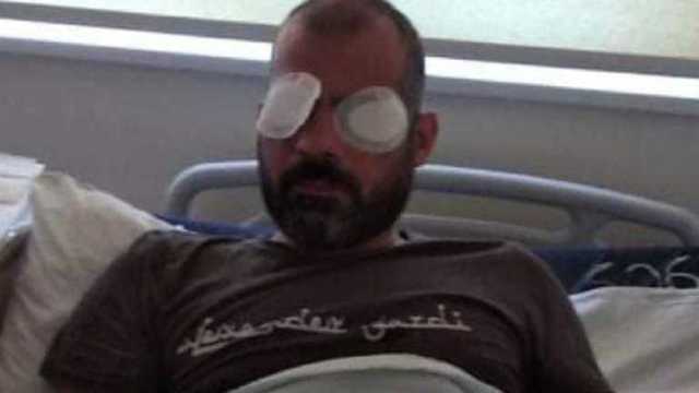 В Грузии на один глаз ослеп оператор, которого избили противники ЛГБТ