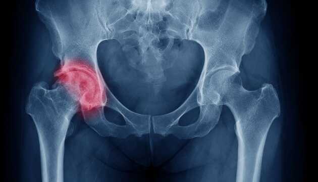 Коронавирус уничтожает тазобедренные суставы – львовские врачи