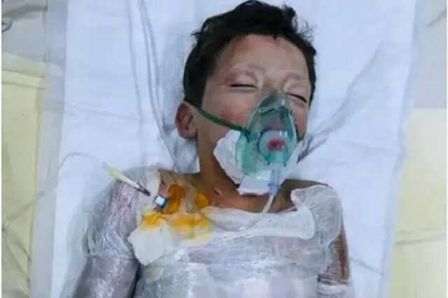 На Кировоградщине 10-летний мальчик облил себя бензином и поджег, пока его мать отвлеклась