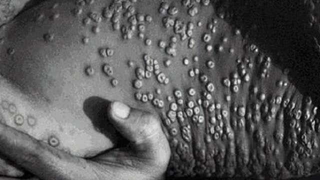 Сотни случаев в мире: МОЗ Украины расcказали о "Обезьяньей Оспе"