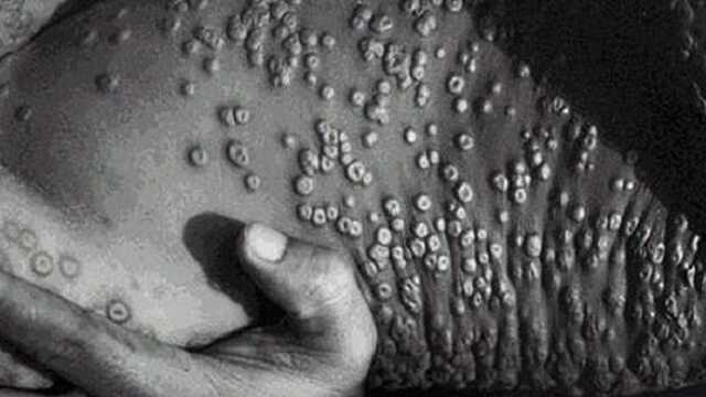 Оспа обезьян. Как распознать и чем лечить