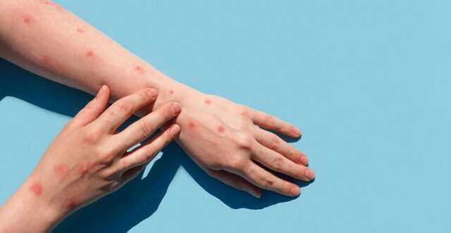 В Україні новий випадок мавп’ячої віспи: чи можлива епідемія