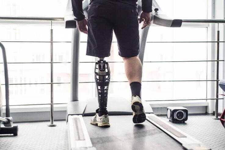 В Україні щомісяця виготовляють 2000 протезів нижніх кінцівок та 200 - верхніх