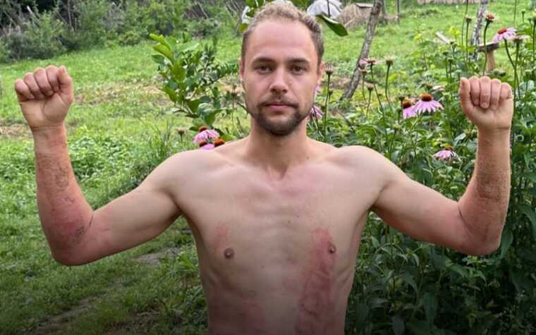 Активіст отруївся борщівником, щоб показати, наскільки ця рослина небезпечна