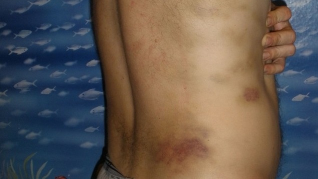 Жертва тортур демонструє сліди катувань (Дмитро Клугер)