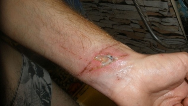 Сліди катувань на зап‘ястку