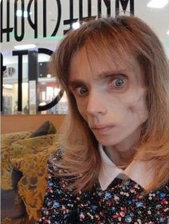 Худеющая россиянка снизила вес до 17 кг: умирающая выкладывает фото и видео
