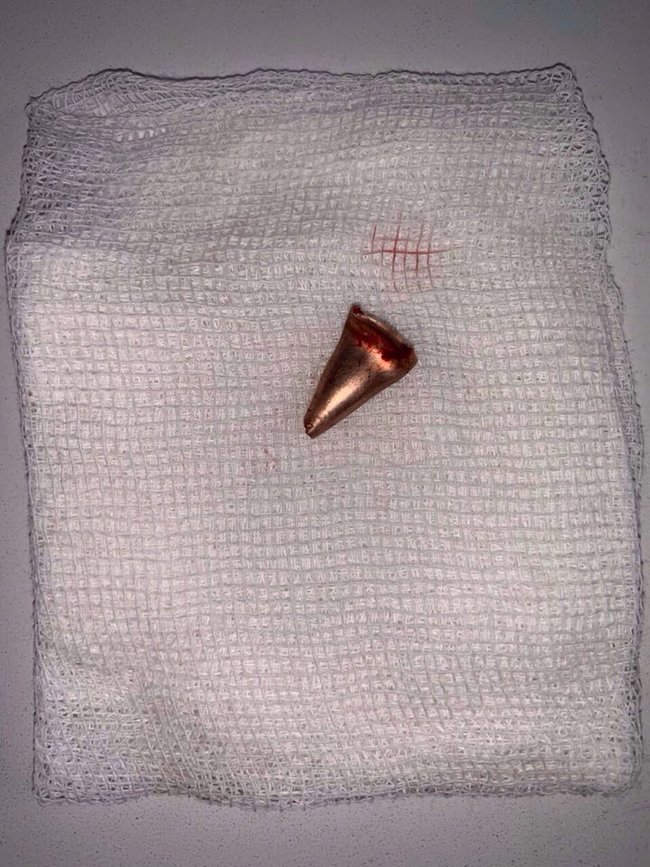 Врачи извлекли пулю из головы раненного украинского воина: у него появились признаки положительной динамики, - главврач больницы им. Мечникова Рыженко 01 Врачи извлекли пулю из головы раненного украинского воина: у него появились признаки положительной динамики, - главврач больницы им. Мечникова Рыженко 01 dqxikeidqxiqqeant