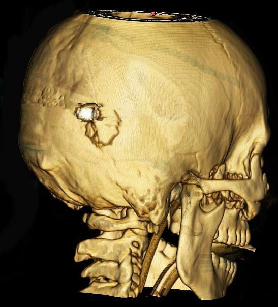 Пуля остановилась в мозге dqxikeidqxitkant