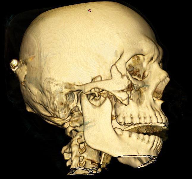 "Пуля залетела под глаз и пробила мозг": врач рассказал о "воскресении" героя ООС