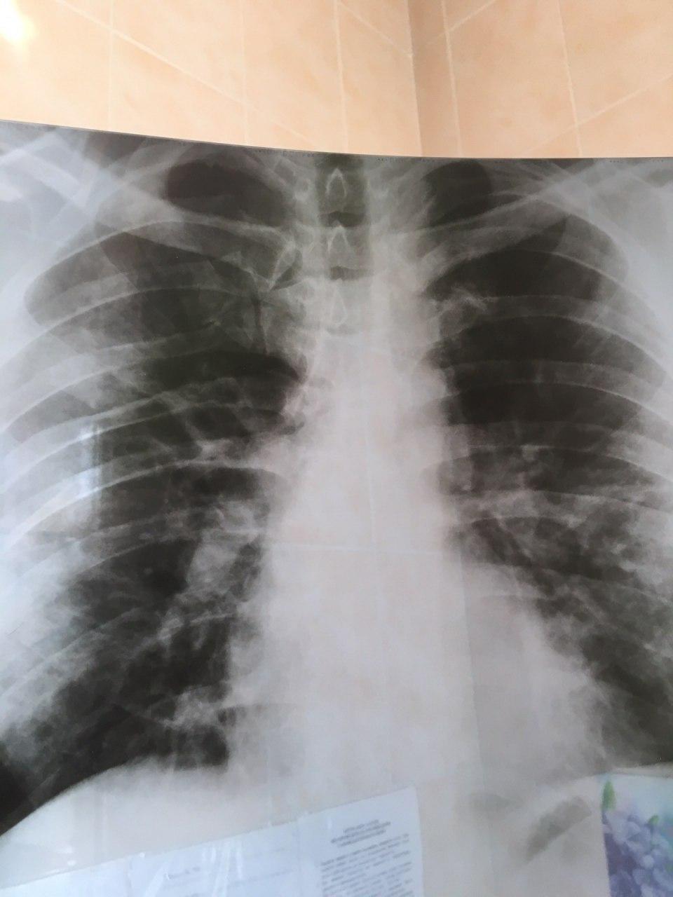  ,    COVID-19 dqxikeidqxiqxxant