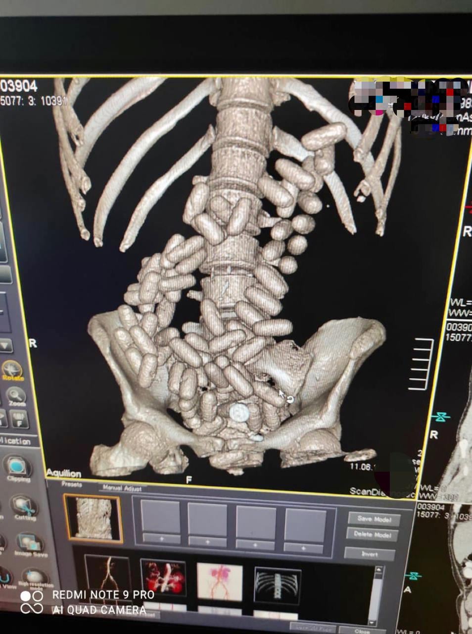 Томограмма желудка наркокурьера dqxikeidqxitkant