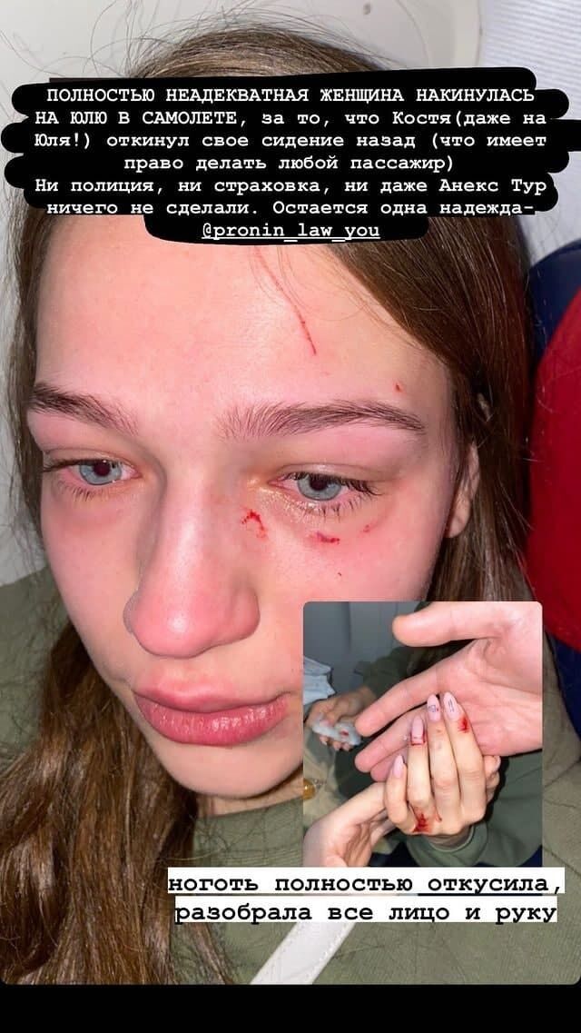 Юлии поцарапали лицо dqxikeidqxitkant