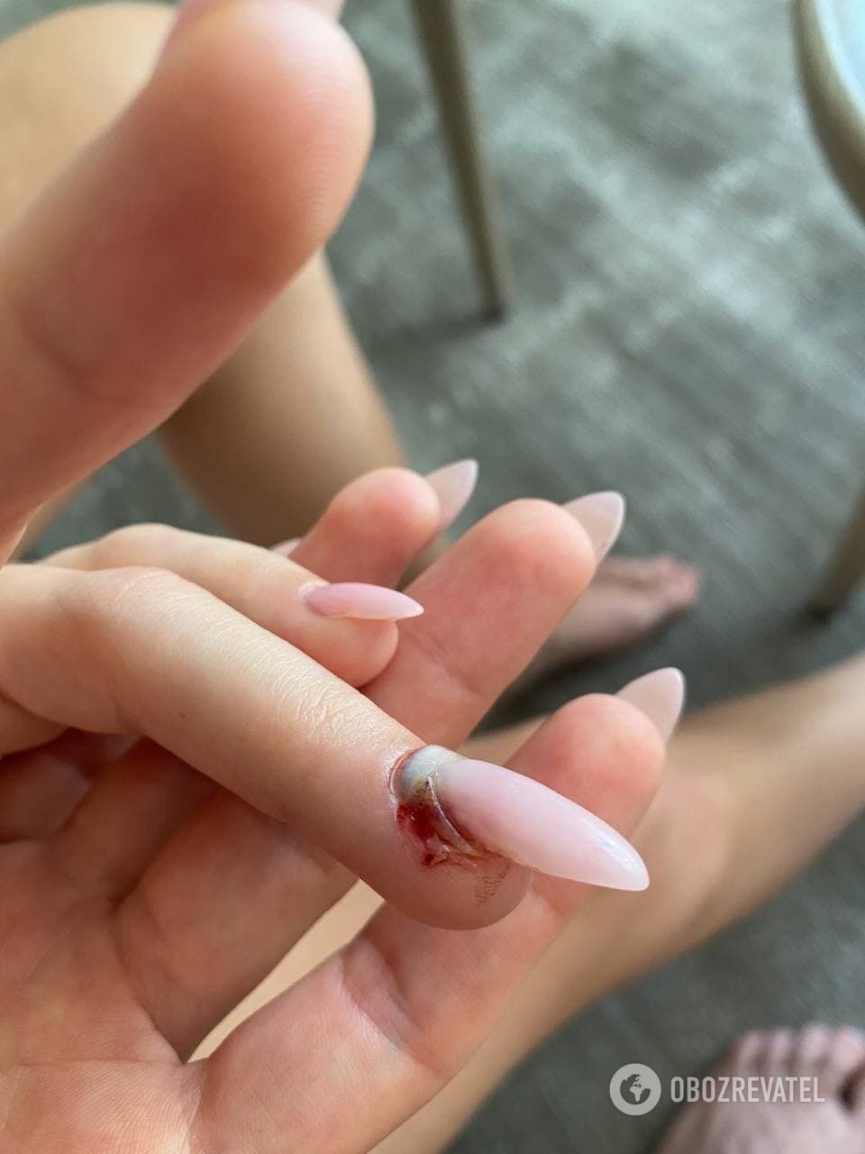 Девушке якобы отгрызли ноготь