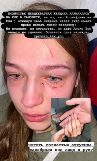 Юлия, которая пострадала во время конфликта в самолете dqxikeidqxiqqeant