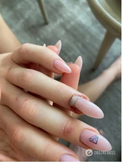 Девушке якобы отгрызли ноготь