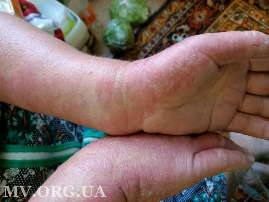 Женщина заработала химический ожог во время сбора черешни dqxikeidqxitkant