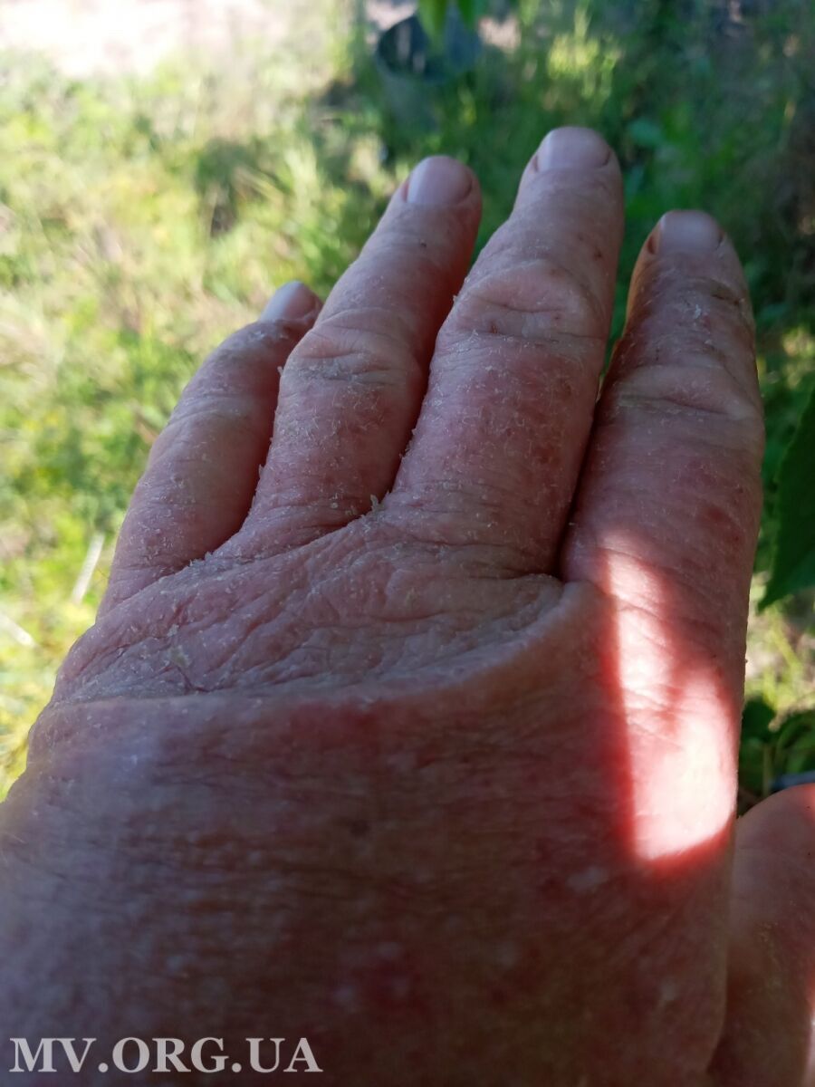 Руки опухли, кожа покраснела и начала шелушиться