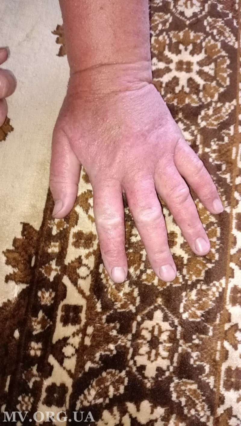 Пострадавшая обратилась к дерматологу