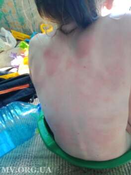 В Кирилловке тело девочки после купания в море покрылось красными пятнами - фото 1 dqxikeidqxitkant