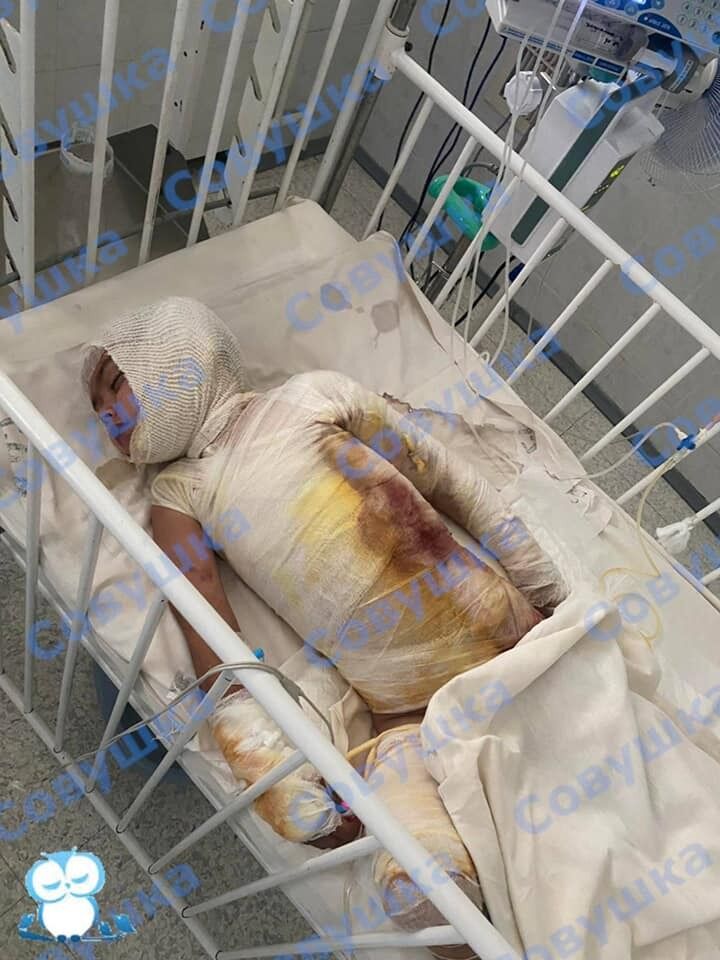 Ребенок получил 40% ожогов тела dqxikeidqxitkant