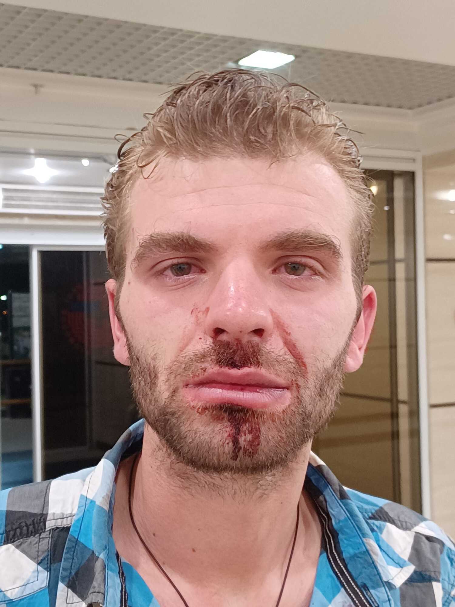 Савину разбили нос