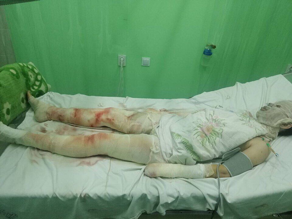 У Насти было 52% ожога тела