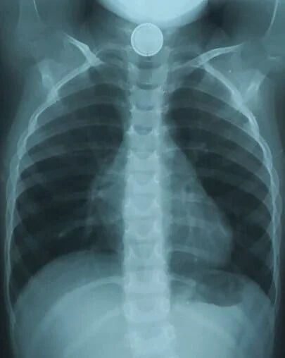 Батарейка пробыла в пищеводе малыша полтора часа dqxikeidqxitkant