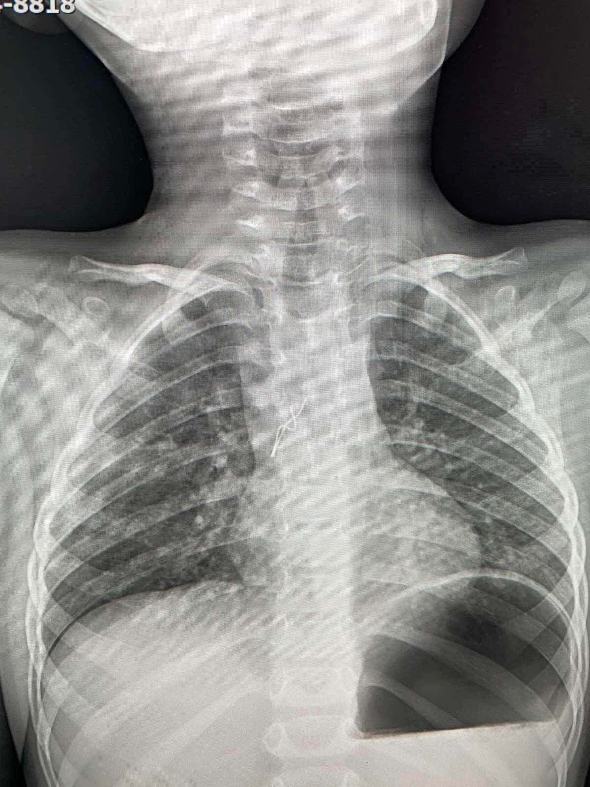 Лампочка попала в трахею ребенка. dqxikeidqxitkant