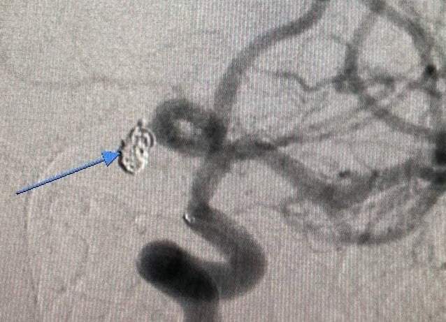 У Дніпрі нейрохірурги провели операцію вагітній dqxikeidqxitkant