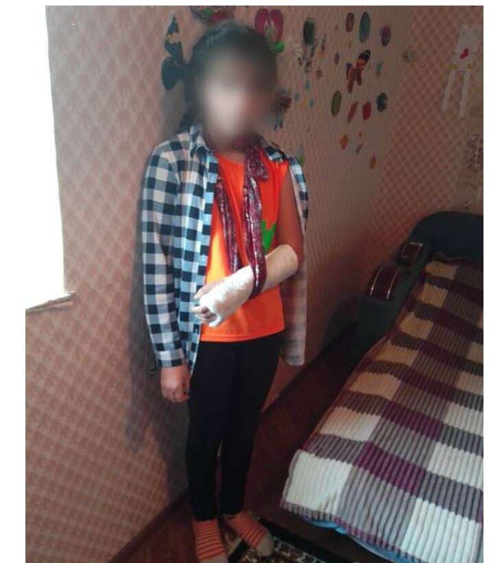 Школьница сломала руку dqxikeidqxitkant