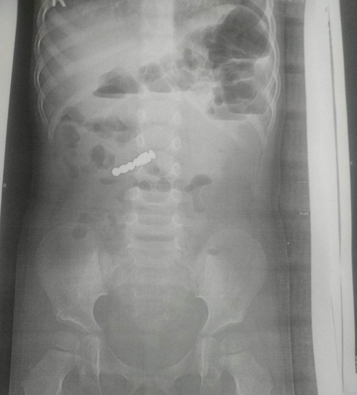 Проковтнула небезпечну іграшку: львівські лікарі врятували 2-річну дівчинку Проковтнула небезпечну іграшку: львівські лікарі врятували 2-річну дівчинку dqxikeidqxiqqeant