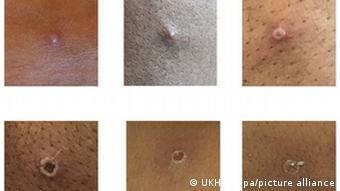 Повреждения на коже человека, заболевшего оспой обезьяны dqxikeidqxitkant